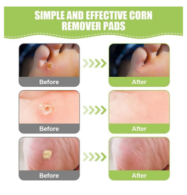 20 Parches Removedor De Callos Y Verrugas Alivia Dolor Sin Aroma