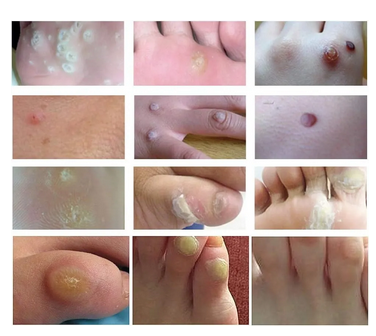 20 Parches Removedor De Callos Y Verrugas Alivia Dolor Sin Aroma